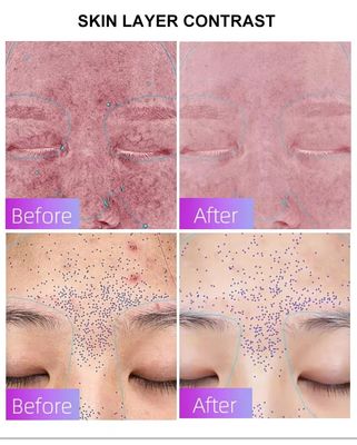شراء Blue Light Acne Treatment Mask with Intelligent Timer – Manufacturer Direct Supply, Appearance Patent Included التصنيع عبر الإنترنت